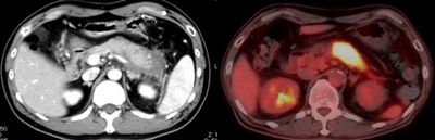膵臓が大きく腫大している自己免疫性膵炎患者のCTとPET CT画像