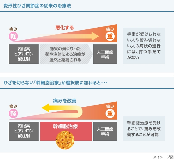 変形性ひざ関節症の従来の治療法/ひざを切らない幹細胞治療が選択肢に加わった場合