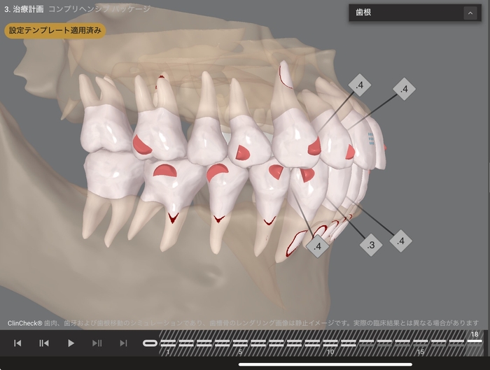 Drによるプランニングシミュレーション（23 → 18ステージ）