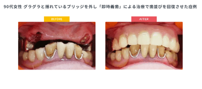 治療で歯並びを回復させた症例