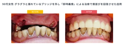 年金生活で「噛むこと」を諦める高齢者が増加 「保険で作れないと思っていた」相談が毎月15件以上 入れ歯保険診療「最後の駆け込み寺」が9/1相談会開始