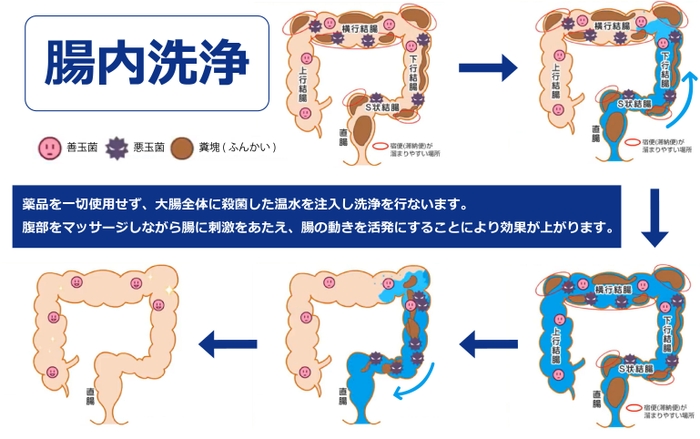 腸内洗浄とは?