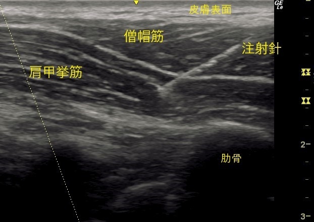 僧帽筋の奥にある肩甲挙筋に針が刺入
