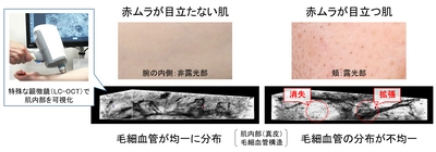 肌の内部構造を可視化し、色ムラが生じるメカニズムを解明　 紫外線による局所的な毛細血管の消失と拡張が 赤色のムラを生じさせる