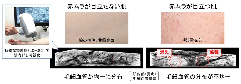 肌の内部構造を可視化し、色ムラが生じるメカニズムを解明　 紫外線による局所的な毛細血管の消失と拡張が 赤色のムラを生じさせる