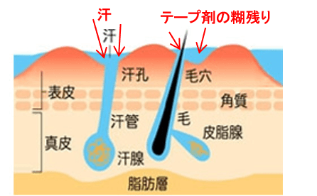 汗による汗管の詰まり