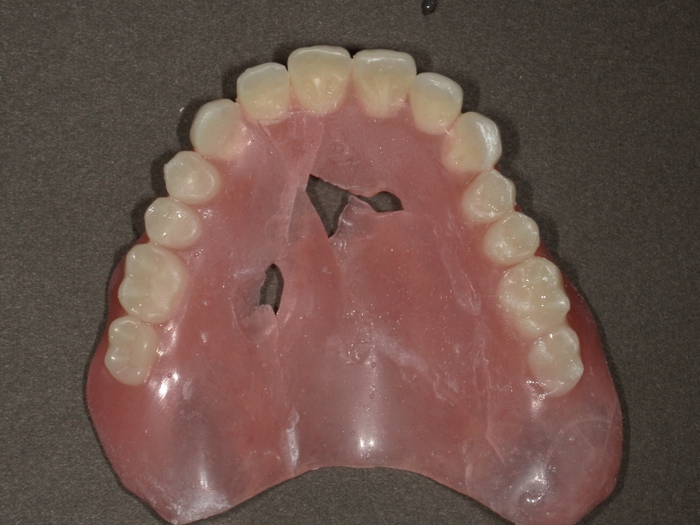 日常で多い入れ歯の破損