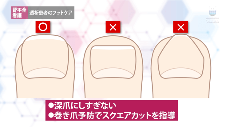 透析患者のフットケア