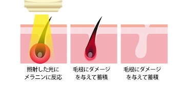 フォトフェイシャル効果も期待できるIPL