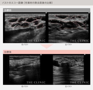 ジェル状充填剤を用いた豊胸術による相次ぐ失敗から 女性を救う専用窓口を開設