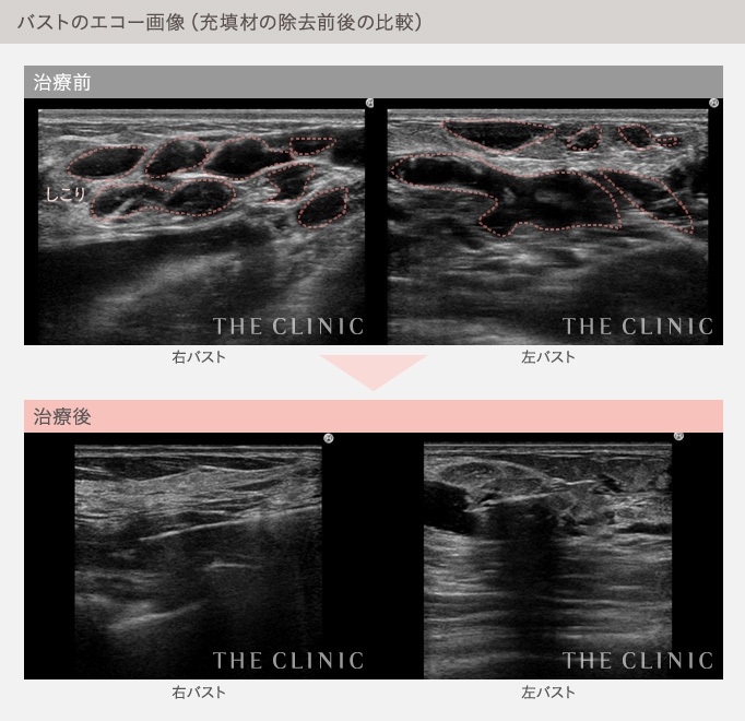 バストのエコー画像(充填剤の除去前後の比較)