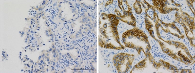 EGFR遺伝子変異肺がんにおける重要な治療標的を確認　がんを抑制する新たな治療法の導入へ大きな期待