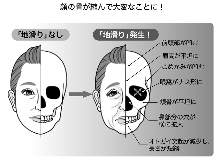 加齢による顔面骨の変化（本文より）