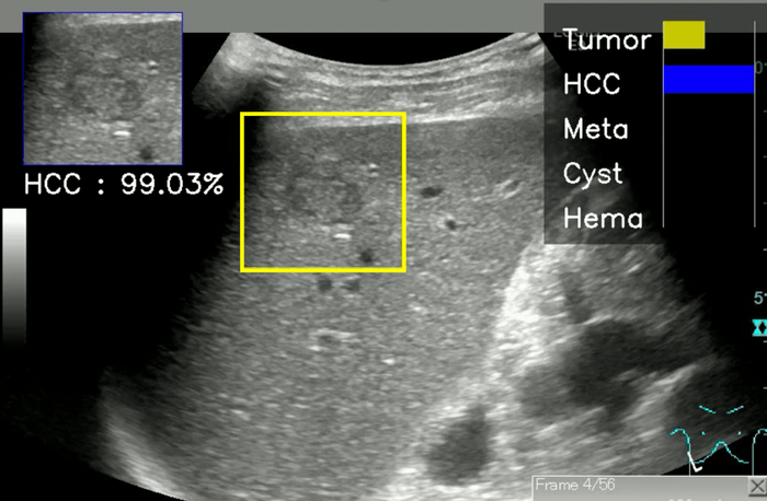 【開発したAIのデモ画面】黄色の四角形で囲まれた部分に肝腫瘤（Tumor）が存在する場合の推定確率、およびこの腫瘤が肝細胞癌（HCC）、転移性肝癌（Meta）、肝嚢胞（Cyst）、肝血管腫（Hema）とした場合の推定確率が、画面右上にグラフで表示されている。また、左上には最も高い推定確率を示す腫瘤の診断名とその推定確率が数値で示される。この画像の場合、肝細胞癌（HCC）である確率が99.03%と表示されている。