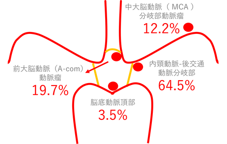 脳動脈瘤発見部位