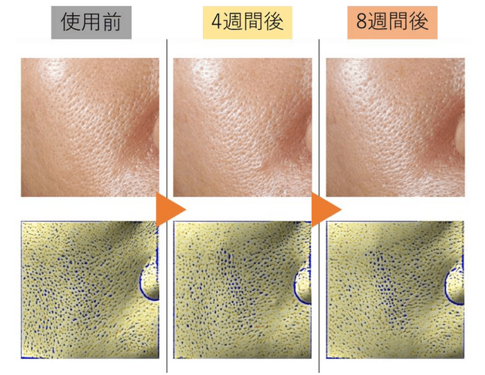 図3　写真およびANTERA 3Dのイメージング解析による毛穴の変化の様子