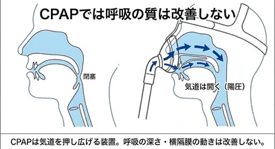 睡眠時無呼吸症候群対策のCPAPはベストな選択肢とは言えない━━CPAPでは"呼吸の質は改善しない”