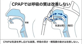 睡眠時無呼吸症候群対策のCPAPはベストな選択肢とは言えない━━CPAPでは"呼吸の質は改善しない”