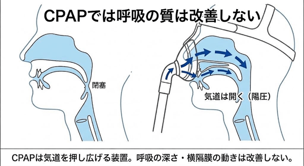 睡眠時無呼吸症候群対策のCPAPはベストな選択肢とは言えない━━CPAPでは"呼吸の質は改善しない”