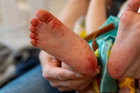 1歳前後で手足口病が増加中
親子で知っておきたい症状と対策