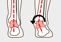 距骨の内倒れ