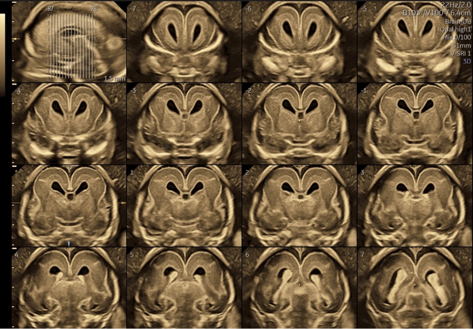 胎児脳の診断はここまで精密な画像で行わなければならないと夫医師は話す