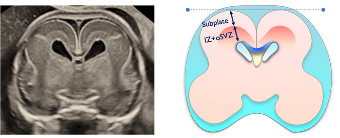 胎児脳サブプレート研究