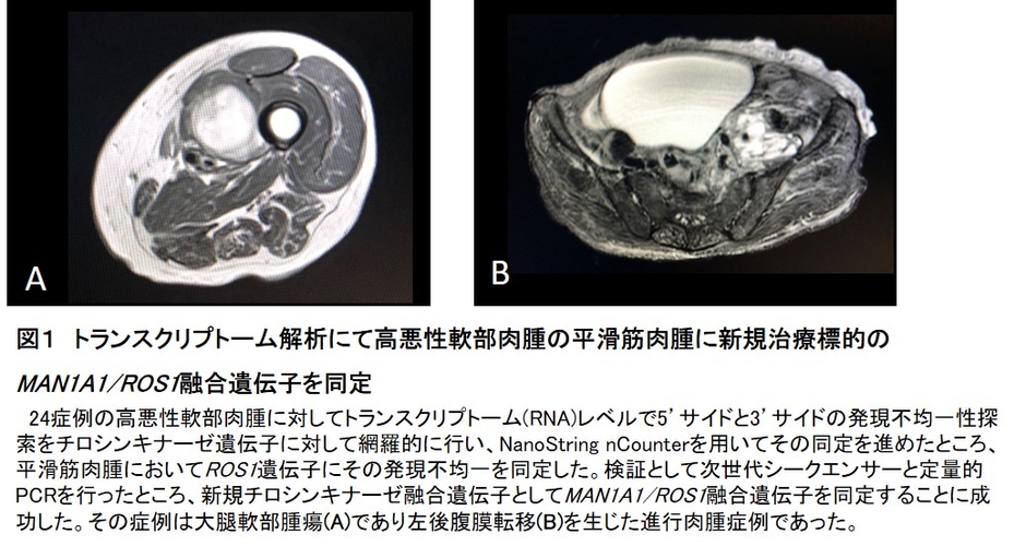 図1 トランスクリプトーム解析にて高悪性軟部肉腫の平滑筋肉腫に新規治療標的のMAN1A1/ROS1融合遺伝子を同定