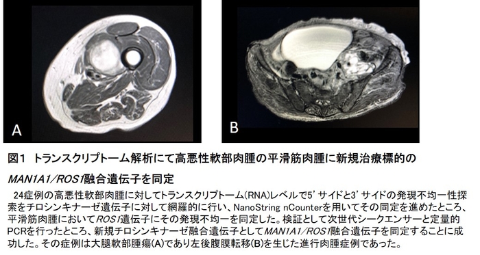 図１　トランスクリプトーム解析にて高悪性軟部肉腫の平滑筋肉腫に新規治療標的のMAN1A1/ROS1融合遺伝子を同定