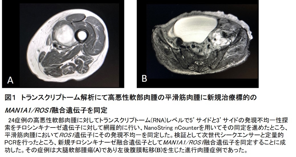 他の種類の軟部肉腫
