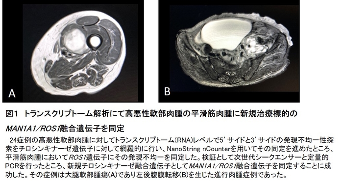 図1 トランスクリプトーム解析にて高悪性軟部肉腫の平滑筋肉腫に新規治療標的のMAN1A1/ROS1融合遺伝子を同定