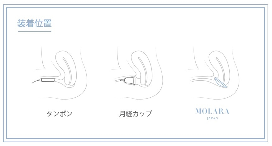 月経ディスクの挿入箇所