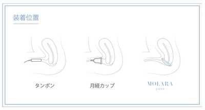 月経ディスクの挿入箇所