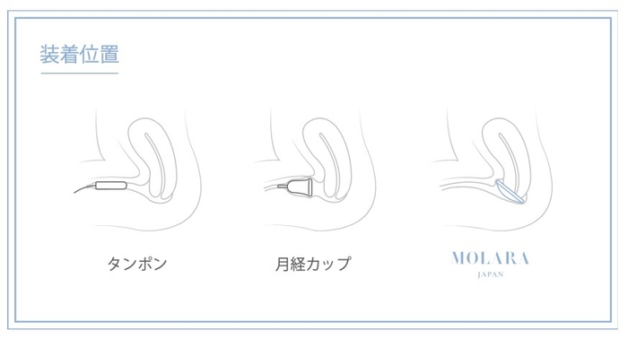 月経ディスクの挿入箇所