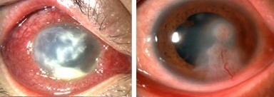 角膜潰瘍(左:細菌性角膜炎 右:真菌性角膜炎)