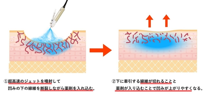 キュアジェットの仕組み