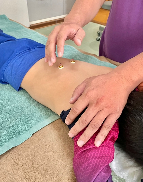 お灸セルフケアの様子