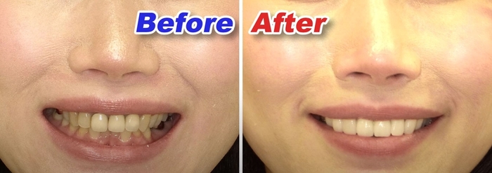 美しい歯と最高の笑顔を手に入れた小河麻理子さんのルミネアーズ治療