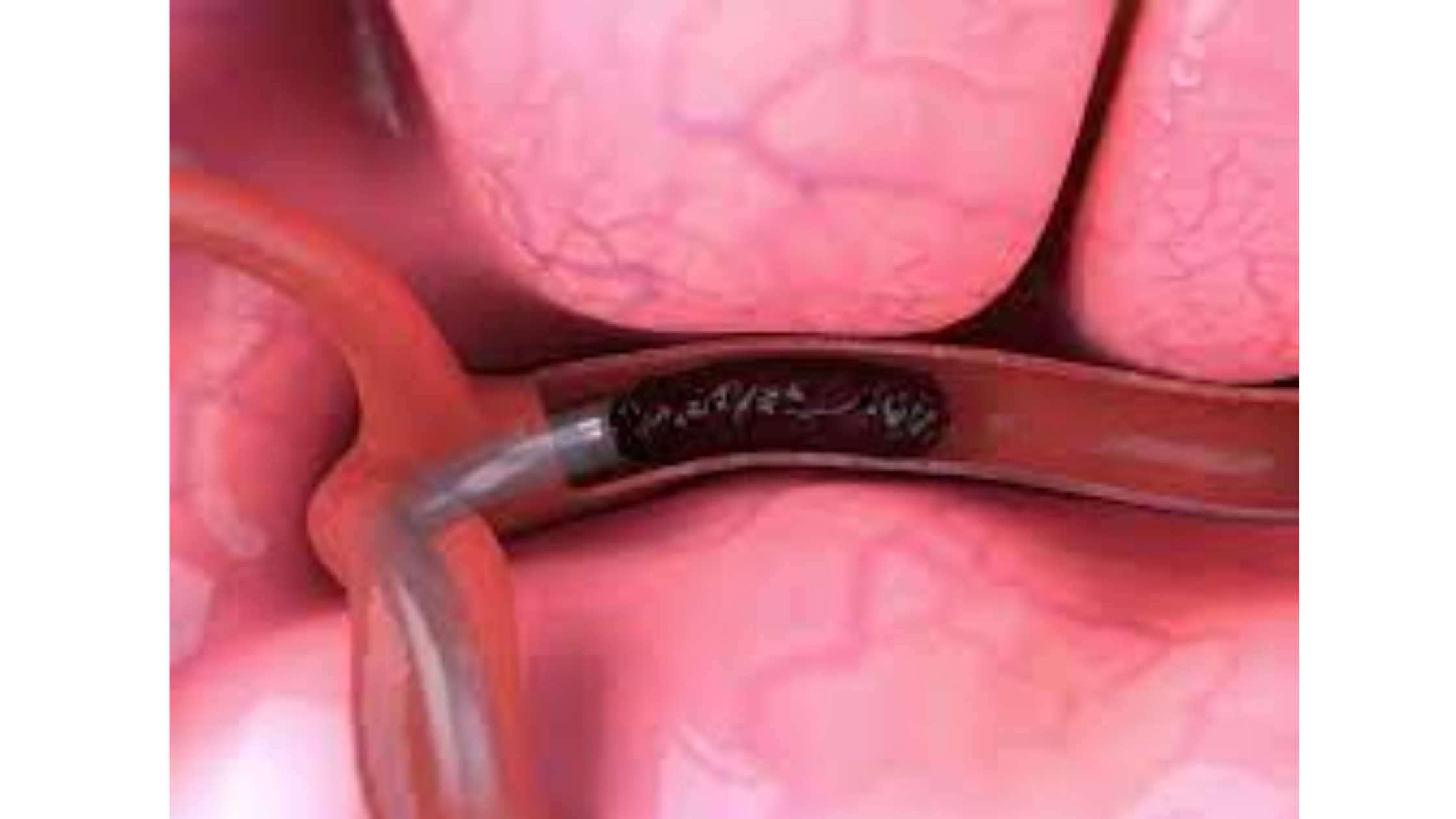 神経幹細胞切除装置の市場規模は2028年までに10億8670万米ドルに達する見込み