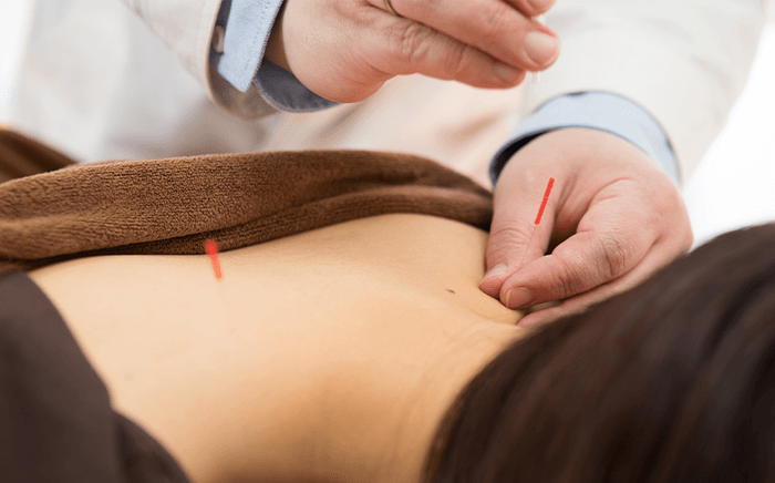 日本の鍼治療は細い鍼を使う