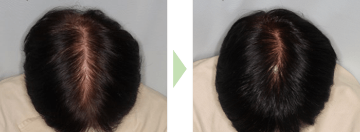 使用前→使用後(60代女性/3ヶ月使用)