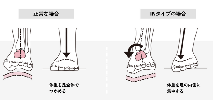 距骨の傾きによる重心のズレ