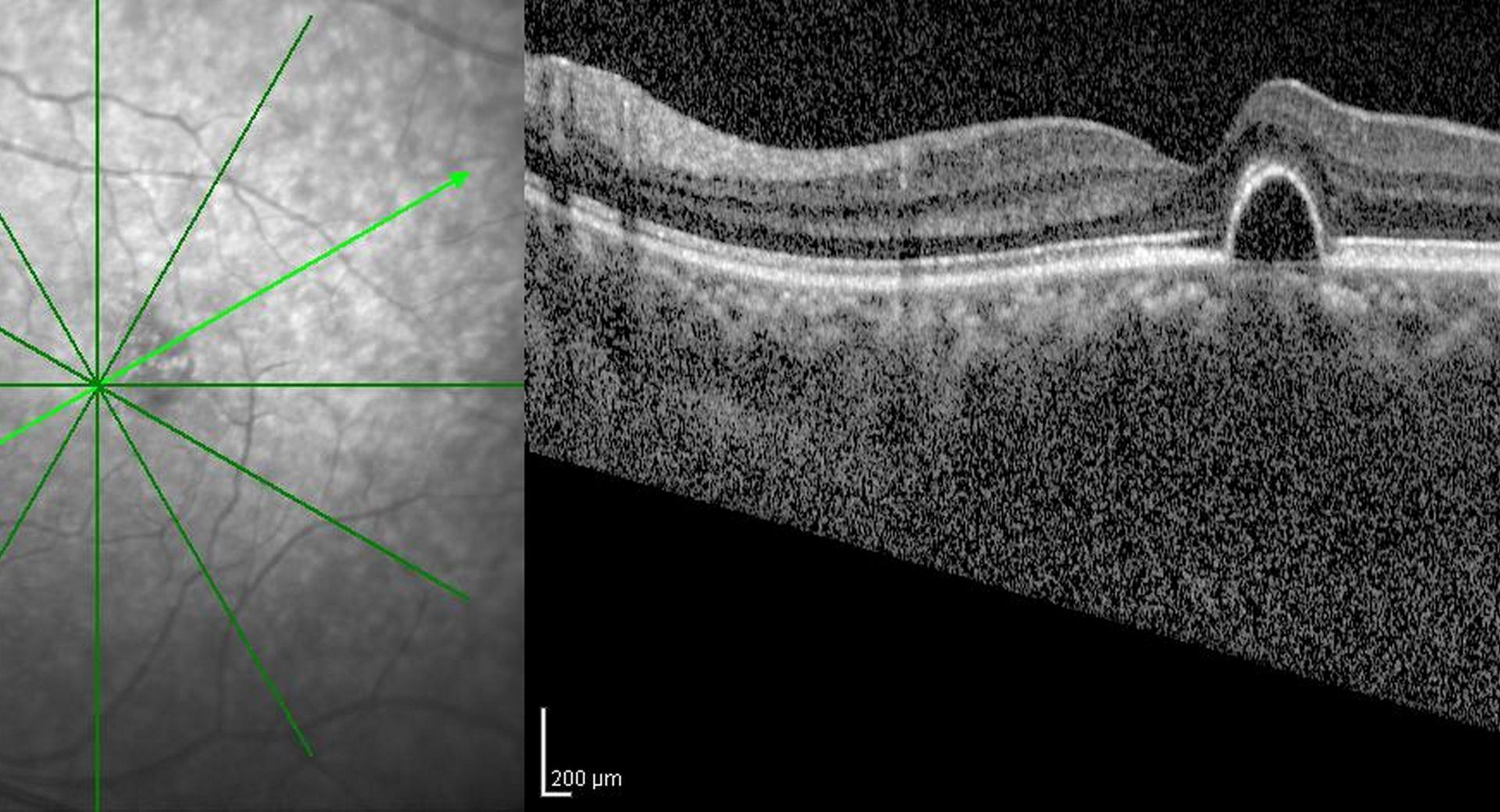 光コヒーレンス・トモグラフィーの市場規模は2026年までに18億6,500万米ドルに達する見込み