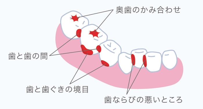 歯垢が残りやすい部分