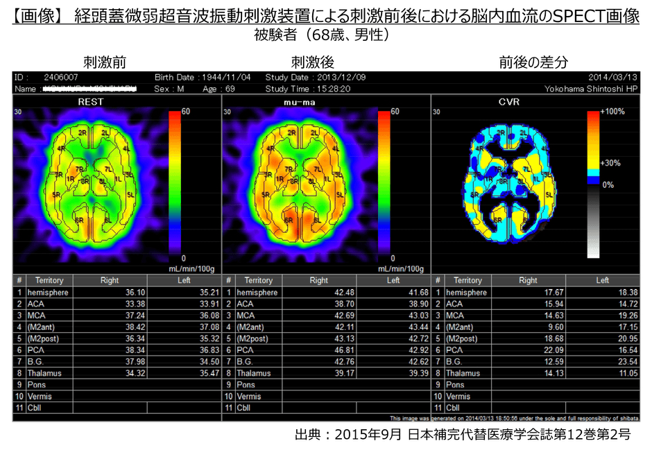 【画像】経頭蓋微弱超音波振動刺激装置による刺激前後における脳内血流のSPECT画像