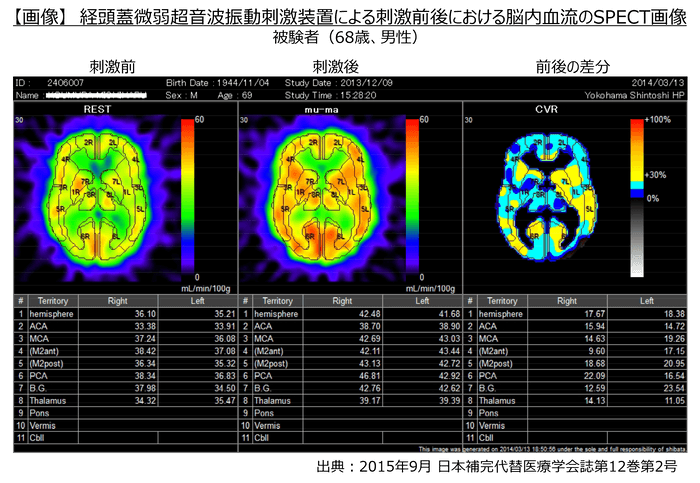 【画像】経頭蓋微弱超音波振動刺激装置による刺激前後における脳内血流のSPECT画像