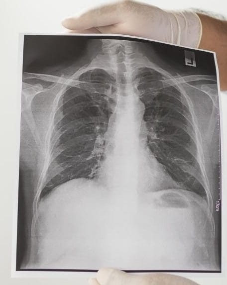 なぜ高齢者の死因に「肺炎」が多いのか?