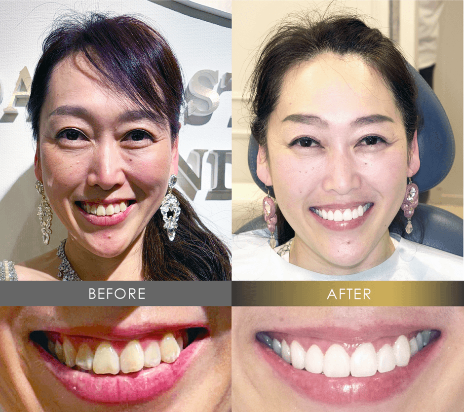 美しい歯と最高の笑顔を手に入れた中田敦子さんのルミネアーズ治療