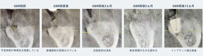GBRからインプラント植立までのCBCT画像