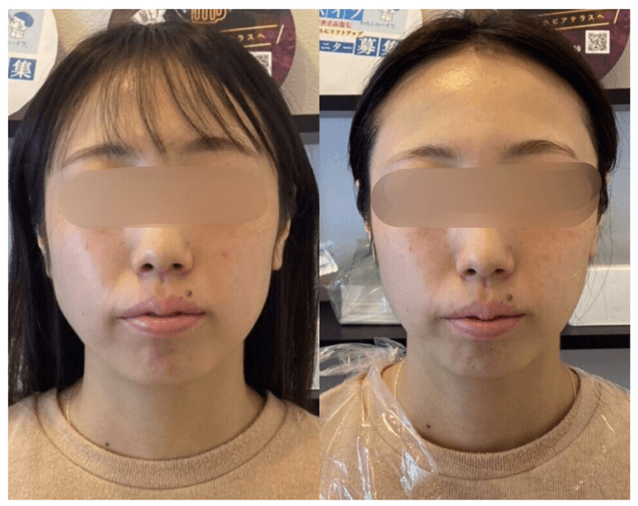 糸リフト・ビフォーアフター